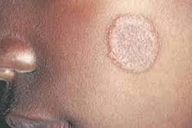 Natural Cures For Ringworm Infections